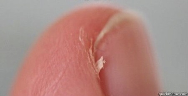 Skin next to nail which hurts!